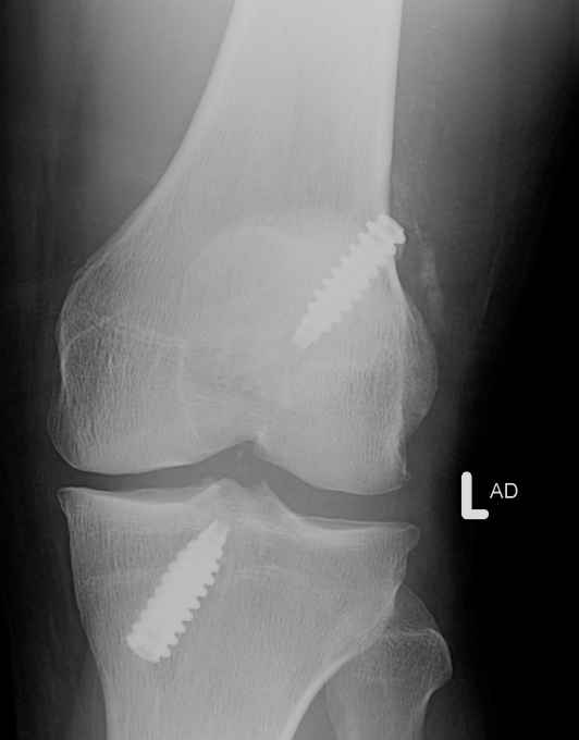 Lars ACL Post op Xray AP